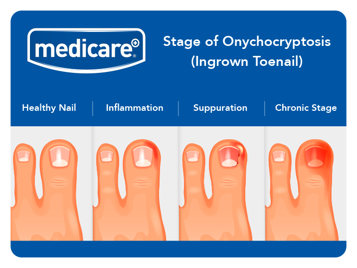 Remove, Repair, Recover Ingrown Toenail Prevention & Treatment
